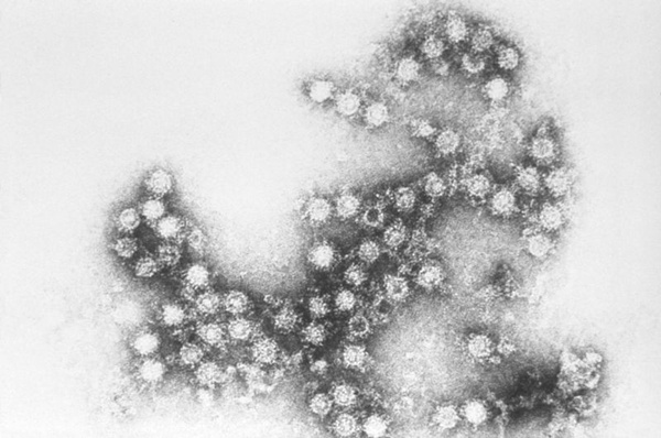 CoxSackie B Virus